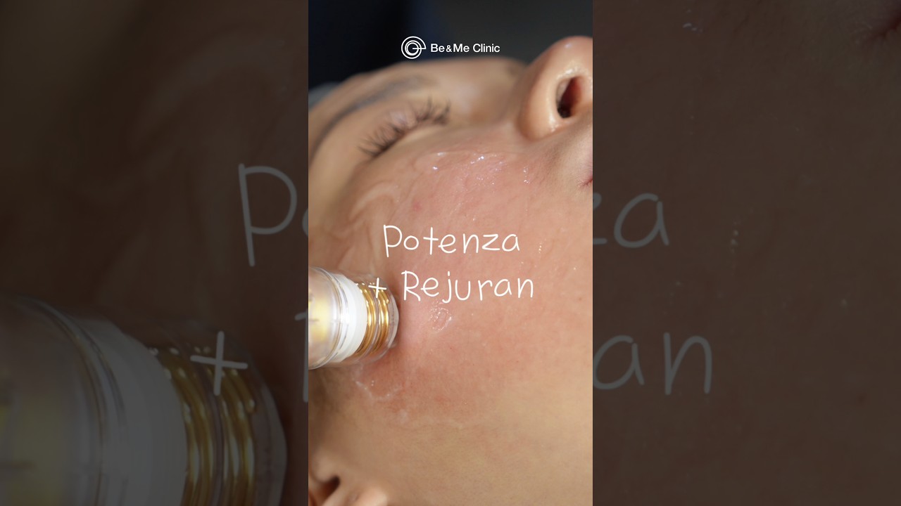 Potenza RF microneedling laser and Rejuran skin booster for comprehensive skin rejuvenation💛