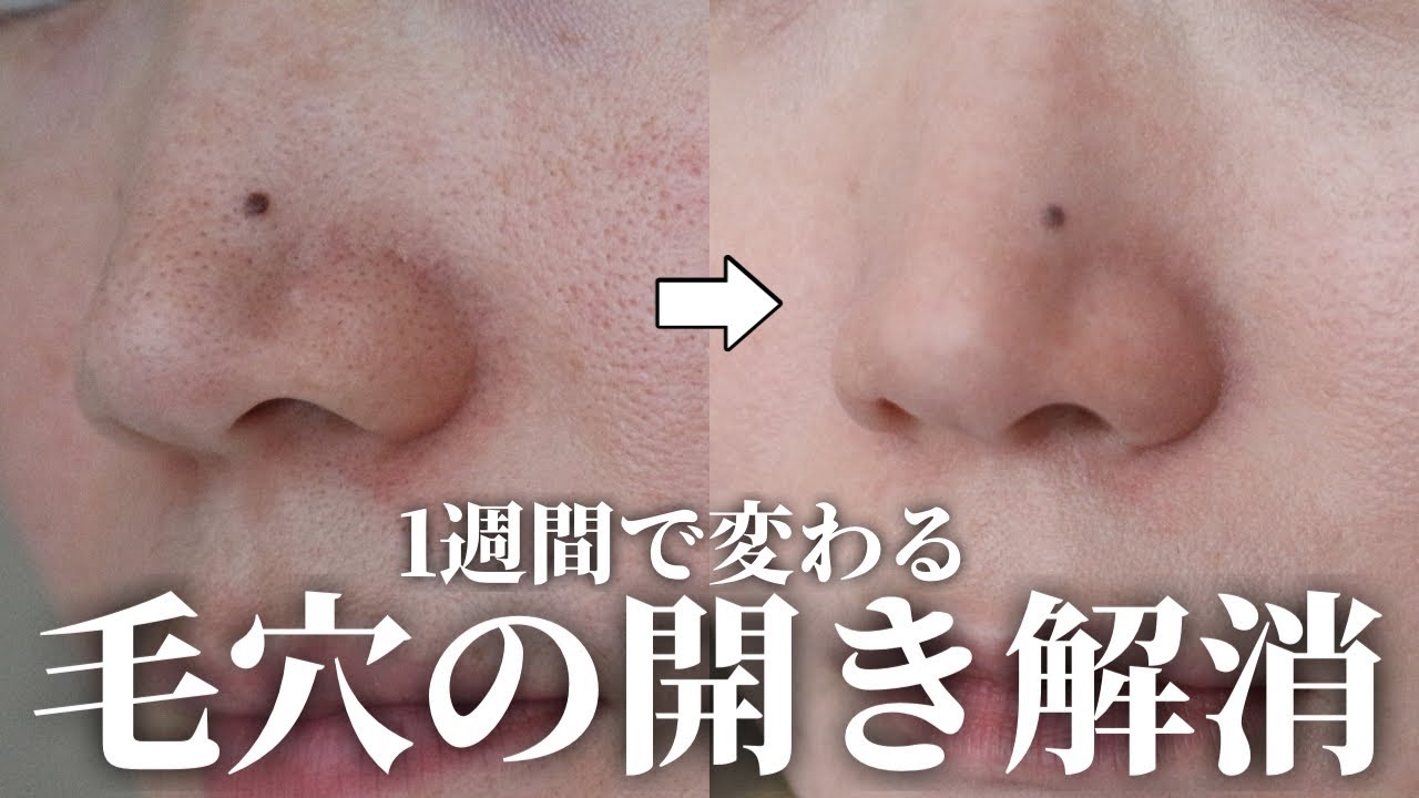 【30代の毛穴悩み解決】つまり・黒ずみ・たるみ毛穴が消えて－5歳若見えする方法！✨