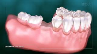 Effects Of Tooth Loss