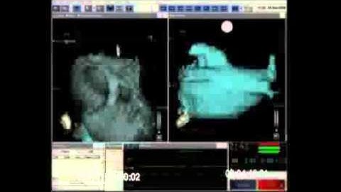 Catheter Ablation for Atrial Fibrillation - Mapping - Arrhythmia.org Webcast 3