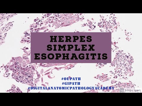 Herpes Esophagitis