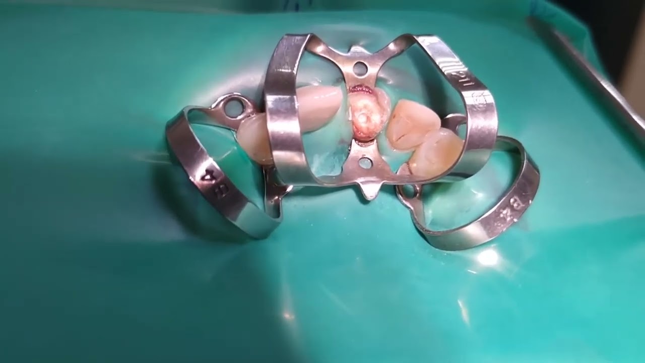 Isolation 13-23 teeth.