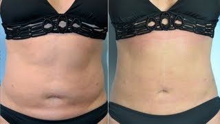 Liposuction Repair and Revision Wealth