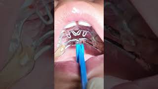 How to activate Expander in the mouth