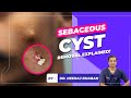 Sebaceous cyst removal explained  by  dr neeraj bhaban