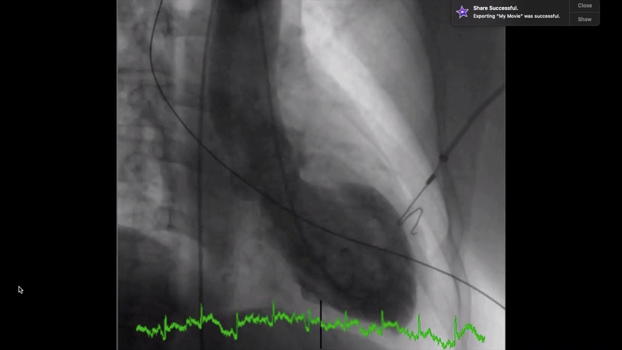 Echocardiogram Of Enlarged Left Ventricle Of Heart Youtube