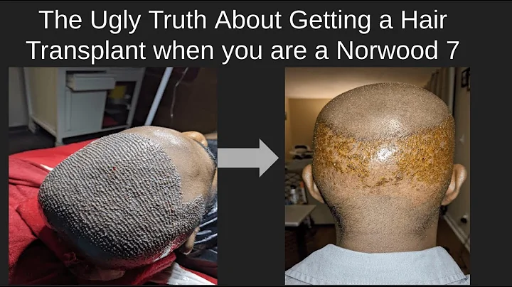 The Ugly Truth about Getting a Hair Transplant whe...