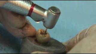 Ss White Great White Amalgam Removal