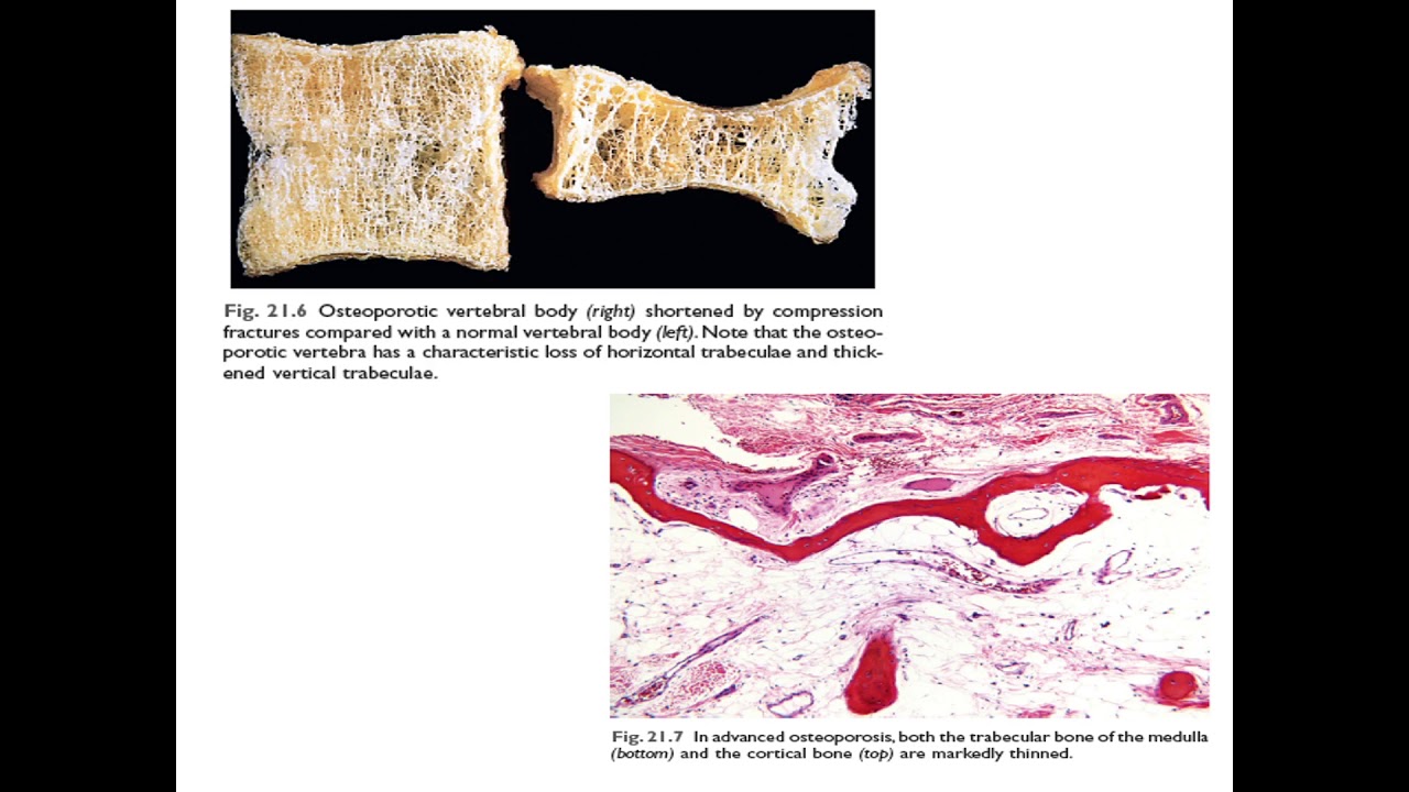 Metabolic Bone Diseases YouTube