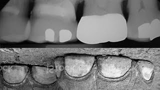 Dental X-ray, elephants foot