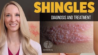 Shingles (Herpes Zoster): Diagnosis, Treatment, Prevention, and Complications. Dermatology Deep dive