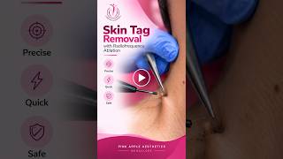Skin Tag Removal in Bangalore | Dr. Pinky Devi Ayyappan | Pink Apple Aesthetics