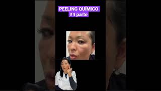 PEELING QUÍMICO 4 parte fotos de la evolución peeling dermamelan mesoestetic peelingquimico