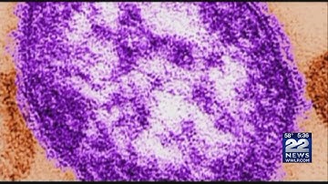 Highly contagious measles virus preventable by vaccination