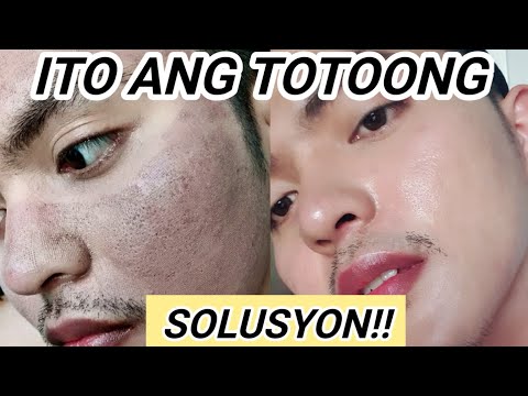 TOTOONG SOLUSYON SA PEKAS SA MUKHA! (Dark Spots, Melasma, etc.)