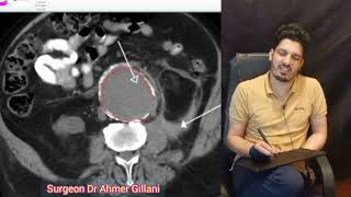CT SCAN Abdomen Showing Abdominal Aortic Aneurysm (AAA) /FCPS PART 2 CPSP MS MD