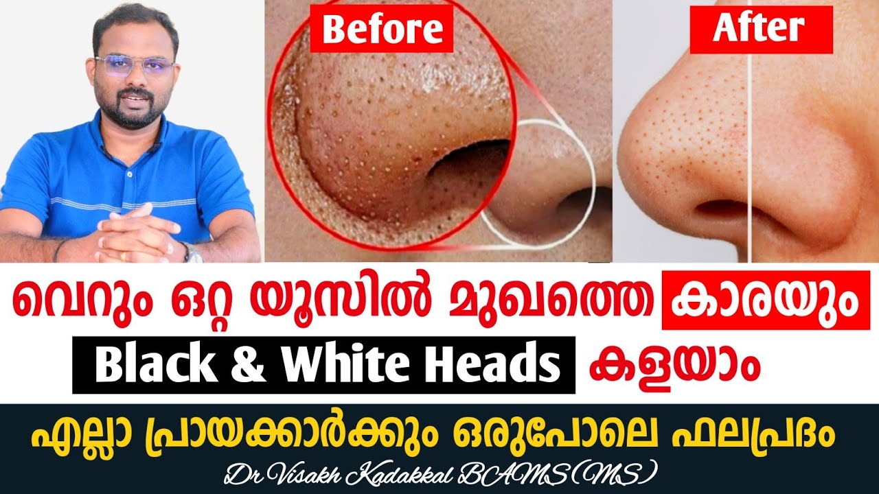 മുഖത്തെ 👃 ബ്ലാക്ക് ഹെഡ്‌സും വൈറ്റ് ഹെഡ്സും കാരയും കളയാം 💯 How to Remove Black heads and White Heads