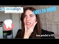 MY FIRST 24 HOURS WITH INVISALIGN