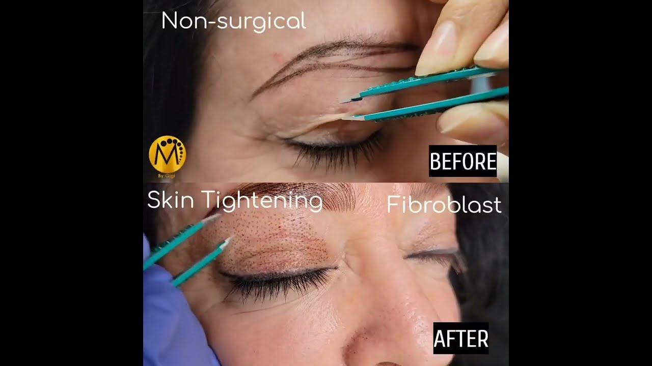 Fibroblast Skin Tightening on Eyelids Before and After YouTube