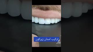 تركيب اسنان زيركون #ابتسامة_المشاهير #حشوات #طب_الاسنان