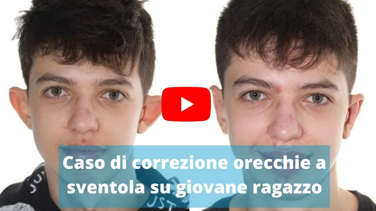 La correzione mini invasiva delle orecchie a sventola con Earfold® 