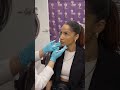Botox Treatment Review – Natural Results & Painless Experience | Vishka Skincare