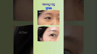  #다크서클없애는법 림피드 #다크서클
