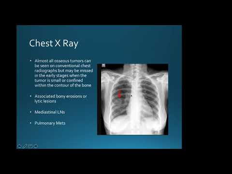 Chest wall tumours: Dr. Harish Mithran, Singapore