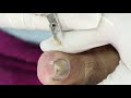 Ep_2165 Toenail removal 👣 เล็บม้วน..แทงเขาเนื้อ เจ็บ เจ็บ 😷 (This clip is from Thailand)