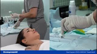 EXO-GROW Dermapen Treatment Demonstration