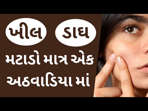 ખીલ અને ડાઘ મટાડવા માટે નો સફળ ઘરેલું ઉપચાર | How to remove pimples | health tips gujarati