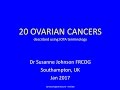 20 ovarian cancers for YouTube 2017