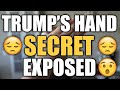 Fighting over TRUMP'S BRUISED HAND | Opie Radio podcast