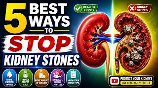 5 Best Ways to Help Prevent Kidney Stones Naturally 💧 | Kidney Stone Prevention Tips
