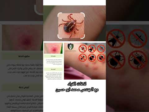 لذغات القراد لا يصدق بالصور