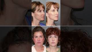 Denver Plastic Surgeons Recent Before and Afters