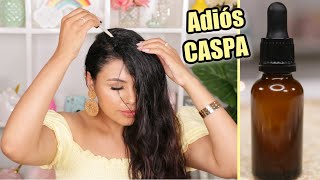 Aplícate unas gotas  de este tratamiento y la CASPA desaparecerá para siempre |fashionbycarol