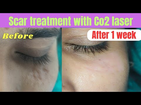 Scar treatment with CO2 Laser| Laser treatment of scar | Best scar treatment #scar