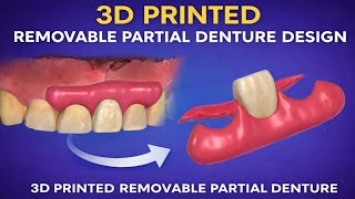 3D Printed Removable Partial Denture Design | Exocad Digital Workflow