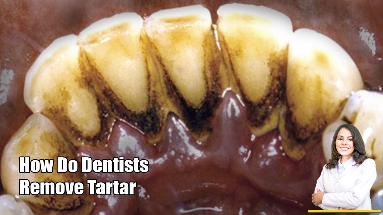 4 Years Without Brushing Teeth Tartar Removal EXTREME CALCULUS