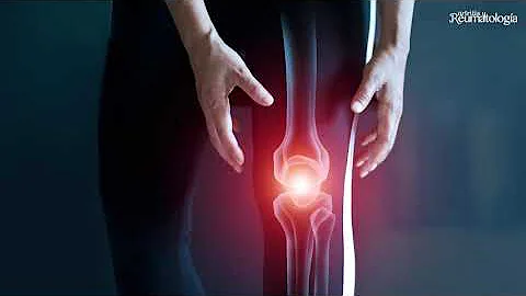 ¿La artritis de rodilla desaparece alguna vez?