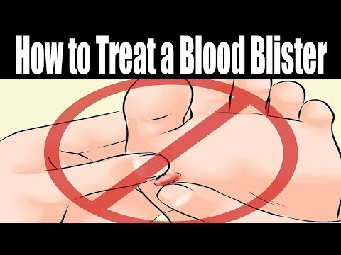 Wie behandelt man eine Blutblase | Wie eine Blutblase entleeren