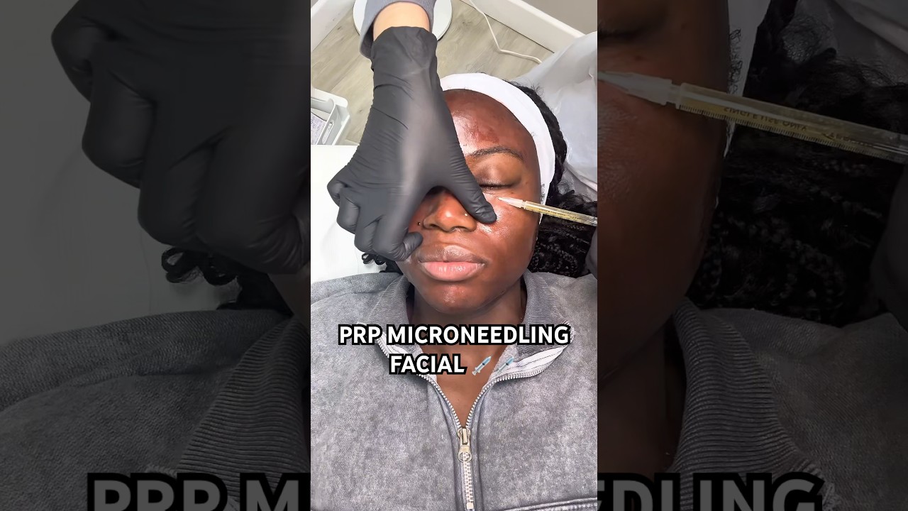Come with me to get a PRP/ Vamprire Facial 💦 
