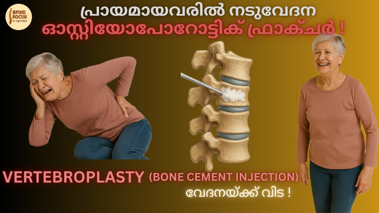 (Vertebroplasty-Bone cement Injection) ഓസ്റ്റിയോപോറോട്ടിക് ...