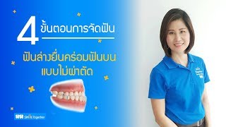 4ขั้นตอนการจัดฟันแก้ไขฟันล่างยื่นคร่อมฟันบน::จัดฟันแบบไม่ผ่าตัด