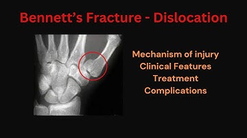 Bennett’s Fracture - Dislocation | Base of the Thumb Fracture| 1st Metacarpal Fracture: Broken Thumb