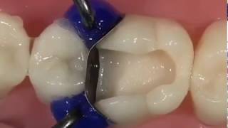 White Composite Filling a Molar - Rajan Dental