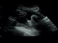 Our Baby Echo Part 5