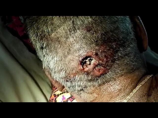 Maggots in a scalp wound  Worms in the head 