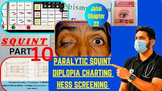 Paralytic Squint | Diplopia Charting | Hess Screening | Squint Part 10